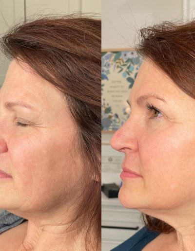 derma filler