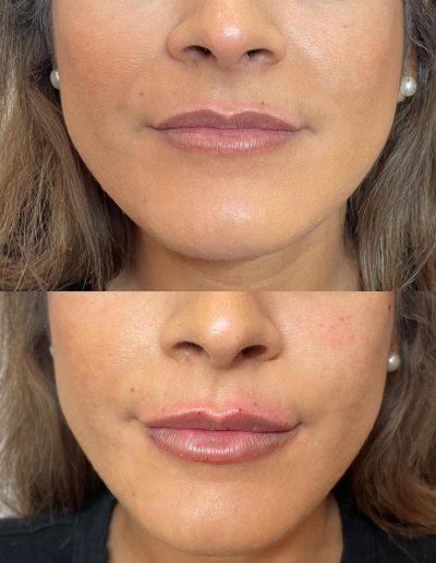 lip filler