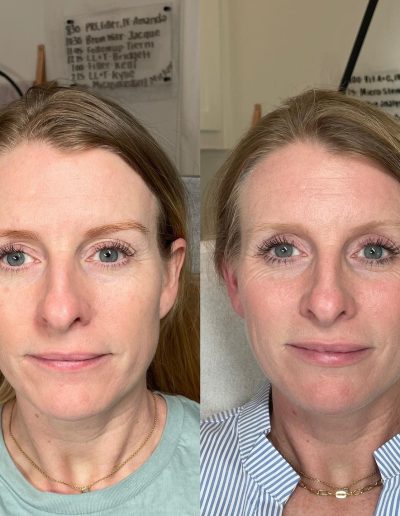 lip filler