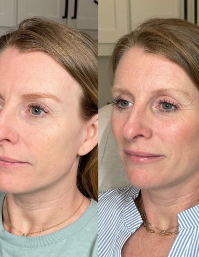derma filler