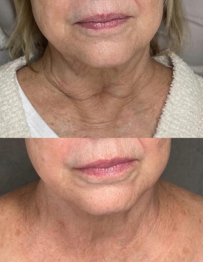 lip filler tyler tx