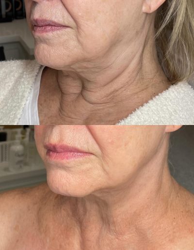 Fillers tyler tx