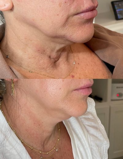 Fillers tyler tx